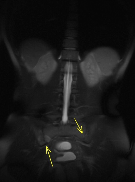 Figure 3 for case Enteropathic arthropathy